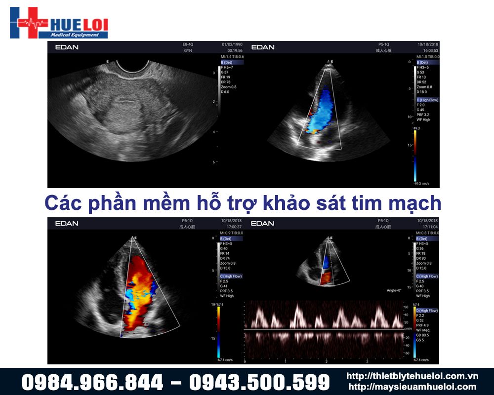 MÁY SIÊU ÂM XÁCH TAY 4D EDAN ACCLARIX AX3